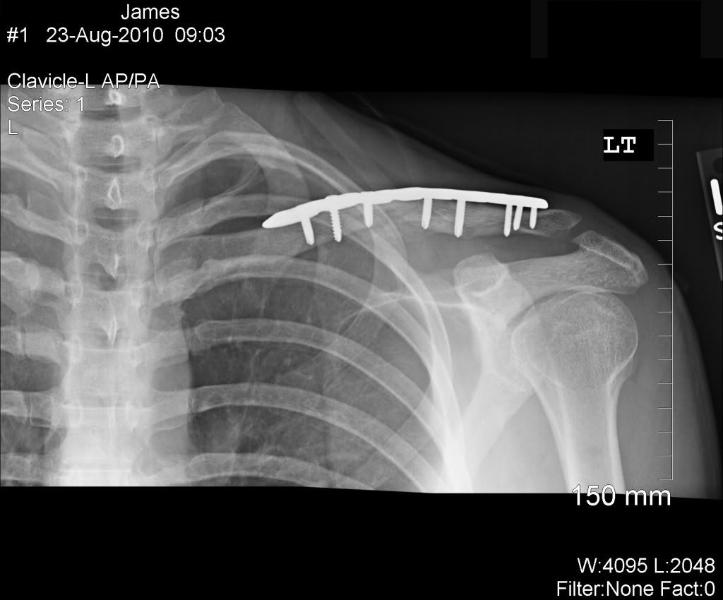 My Fractured Clavicle Timeline With X-Rays - Health & Fitness - ThumperTalk